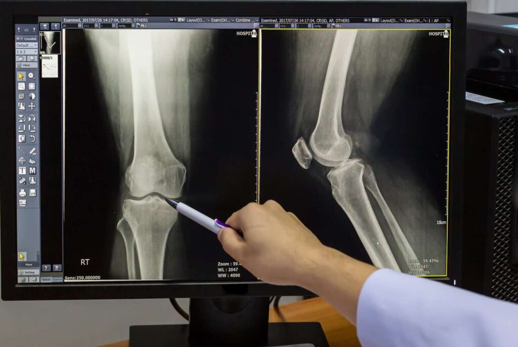 knee replacement services in Mohali - SPAW Hospital