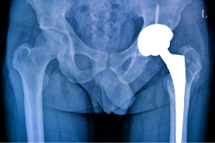 Minimally Invasive Hip Replacement Surgery