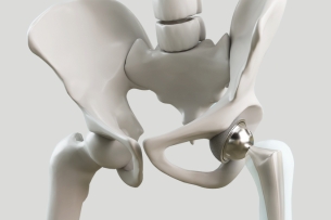 Partial Hip Replacement Surgery