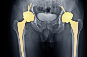 Total Hip Replacement Surgery